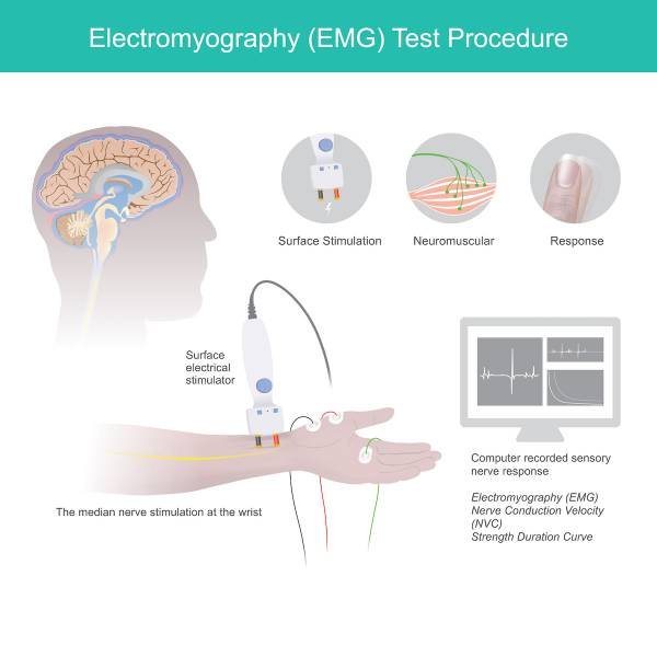 Infographie d'électromyographie